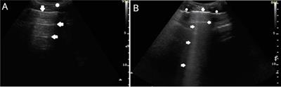 Comparison of pulmonary lesions using lung ultrasound and high-resolution computed tomography in adult patients with primary humoral immunodeficiencies